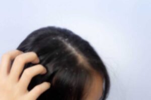 Mengatasi Rambut Berketombe Bagi Pengguna Hijab